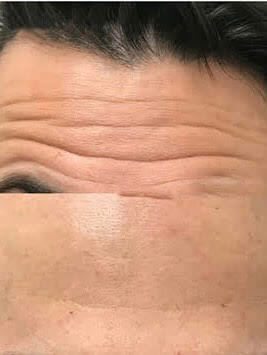 Botox Injections